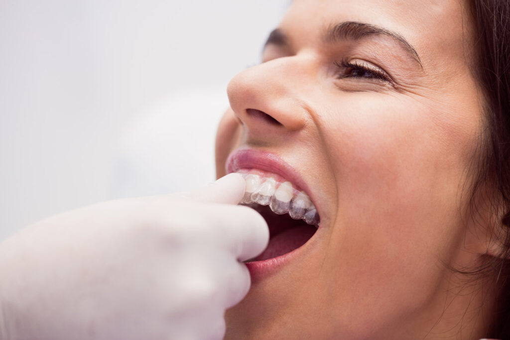 Sleep Apnea Mouthpiece